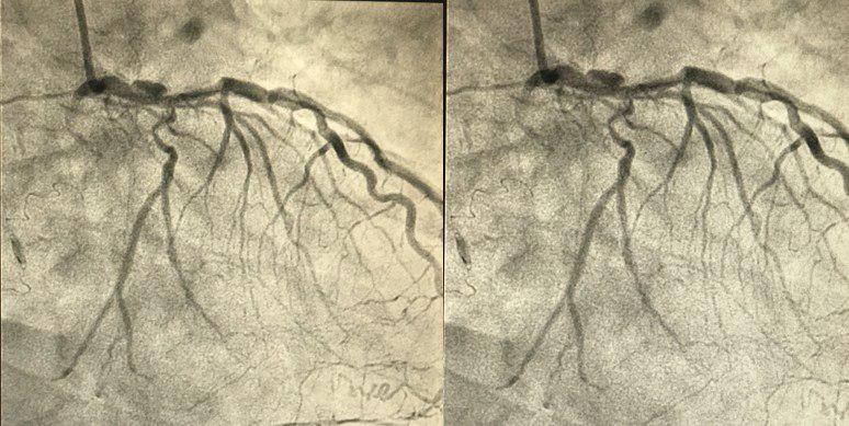 CCG de paciente HIV + con cuadro de angina inestable