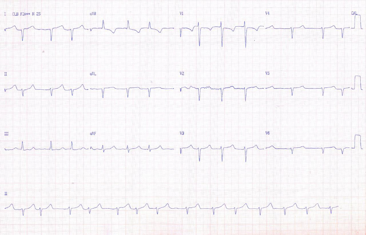 SCA por lesión de TCI en paciente con dextrocardia