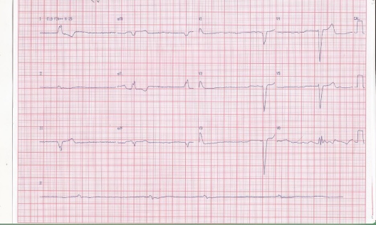 Hombre de 81 años con FA crónica e intoxicación digitálica al que se implanta MP transitorio