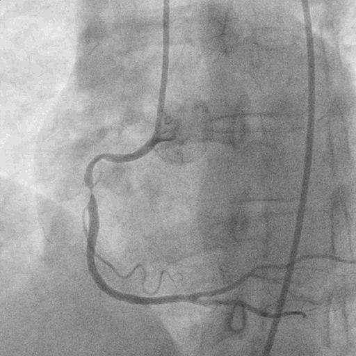 Paciente de 56 años, chagásico, con angor prolongado por lesión en tercio medio de CD y aneurisma de punta de VI