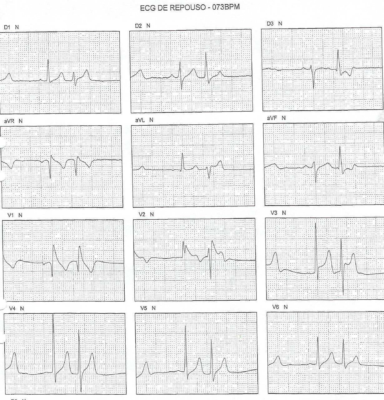 Paciente con precordialgia atípica y Síndrome de Brugada