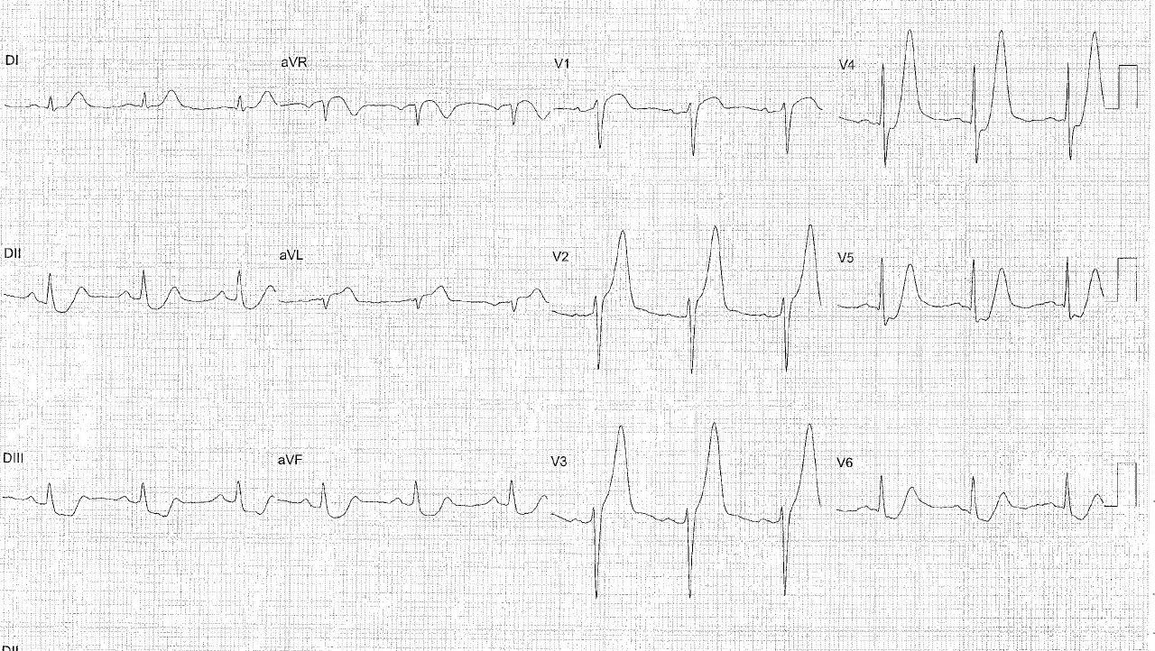 Masculino de 60 años con angor prolongado por oclusión total de la DA
