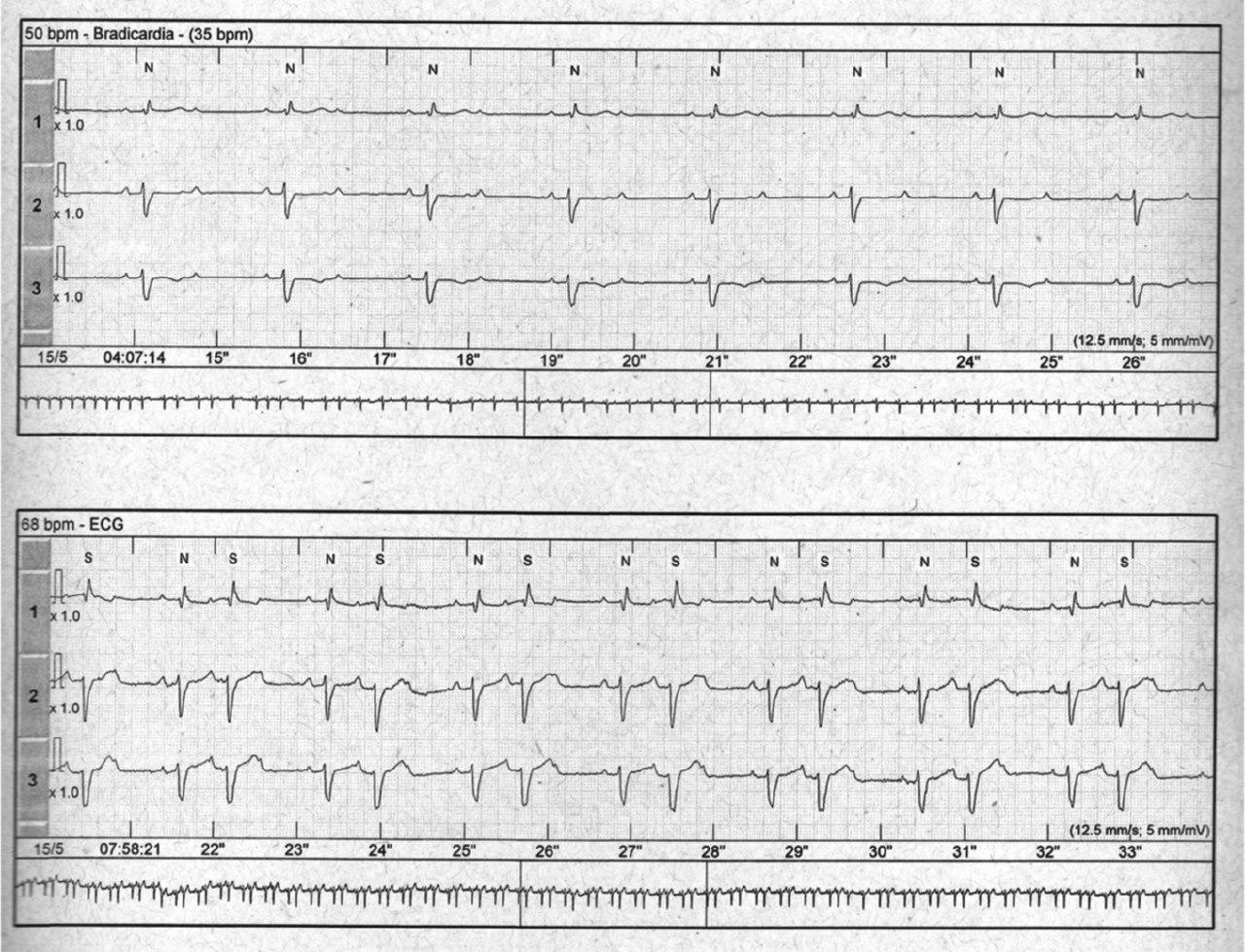 BAV de alto grado y TV polimorfa en mujer de 81 años con episodios sincopales