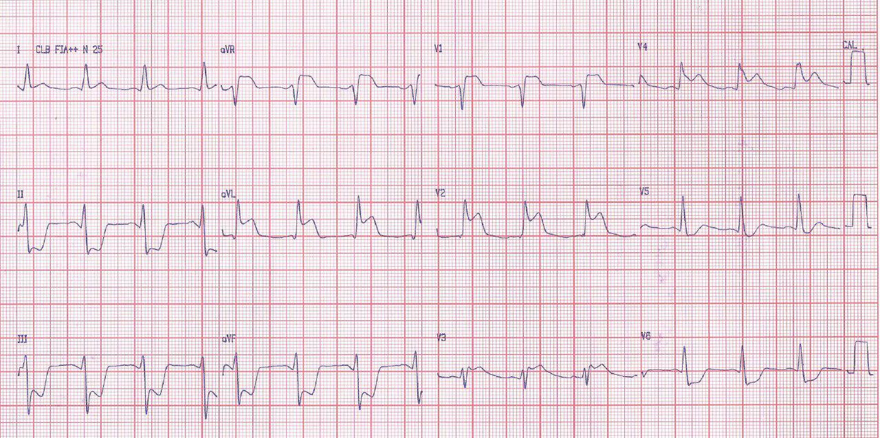 Mujer de 56 años hipertensa con angor prolongado que desarrolla shock cardiogénico por disección aórtica de tipo A