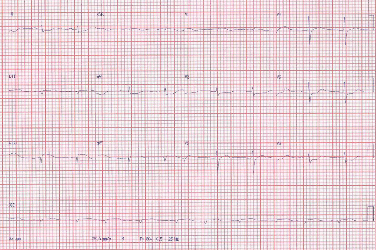 Hombre de 72 años con antecedentes de cirugía de revascularización previa presenta angor prolongado y desarrolla FV