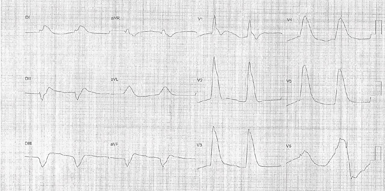 Paciente de 36 años en diálisis por IRC consumidor de crack que desarrolla SCA por oclusión de la DA y FV sin lograrse reperfusión