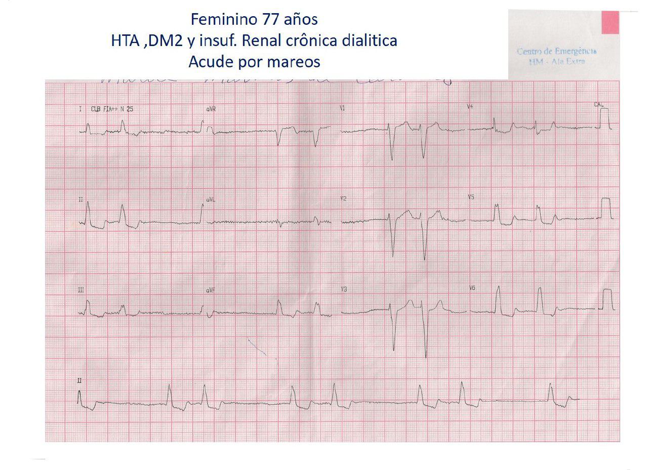 Mujer de 77 años, HTA, diabetes e IRC en diálisis crónica que cursa con hiperpotasemia