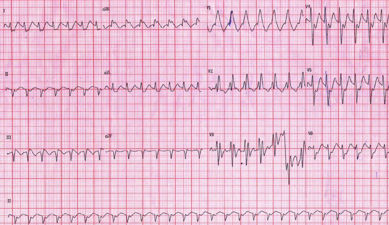 Taquicardia supraventricular con aberrancia por BRD + HbAI en joven de 27 años