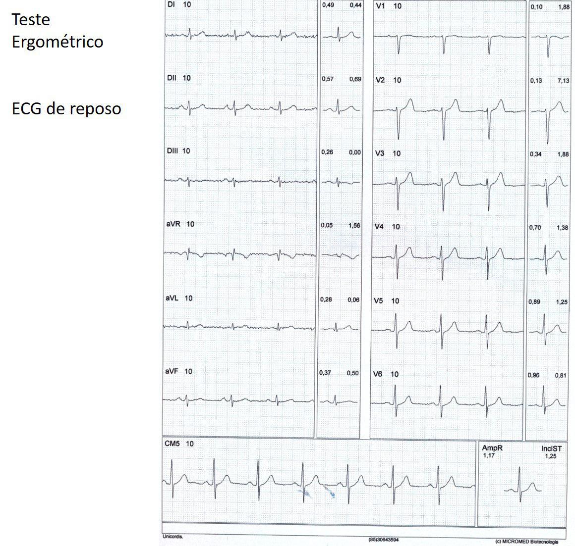 Paciente hipertenso y diabético que solicitó realizarse una ergometría de rutina que demostró isquemia por suboclusión de la DA