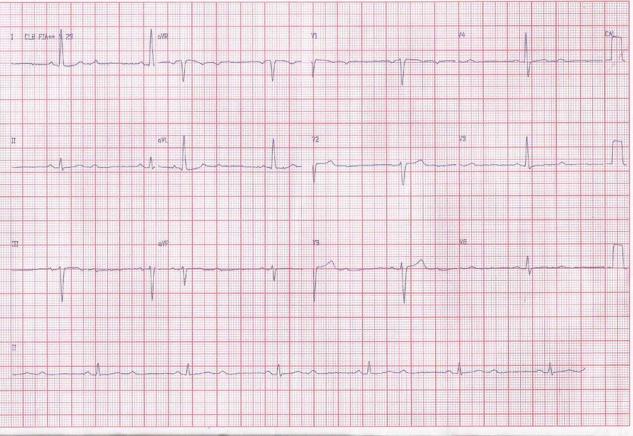 Mujer de 70 años HTA y DBT con angor prolongado y severo trastorno de conducción por lesión de CD