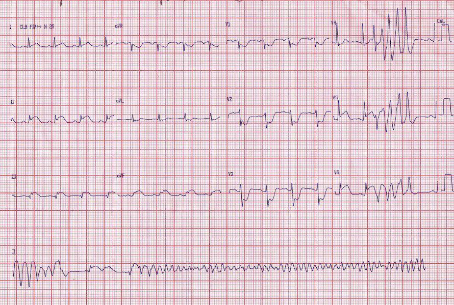 TV polimorfa en IAM por oclusión de Cx
