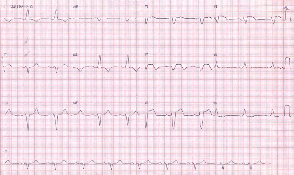 Paciente de 65 años presenta SCA por oclusión de DA proximal con trastorno de conducción alternante y no reperfusión post angioplastia