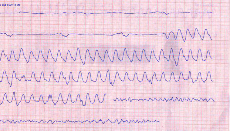 Hombre de 41 años con paro cardíaco extrahospitalario debido a Síndrome de Brugada