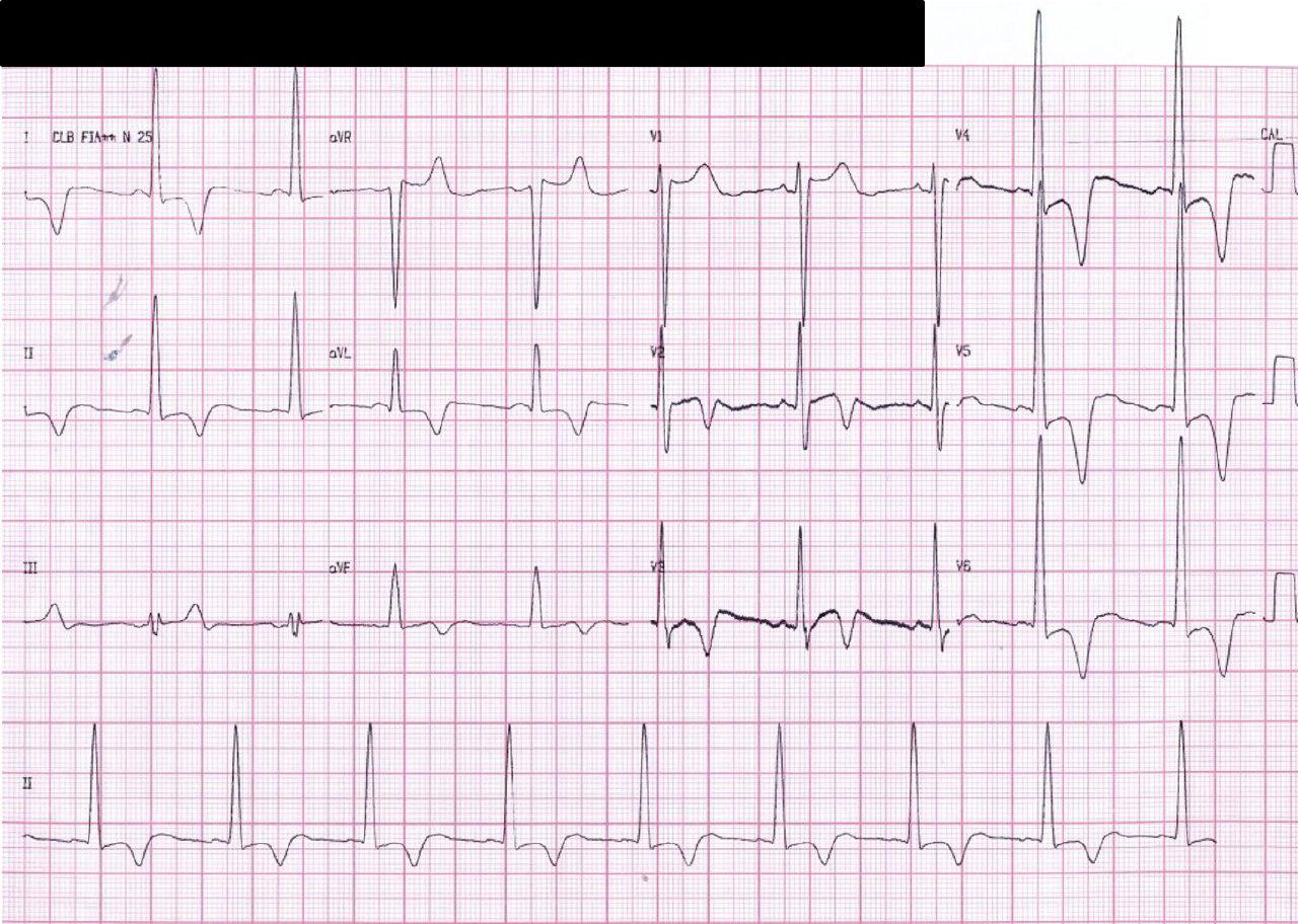 Masculino de 48 años portador de miocardiopatía hipertrófica apical