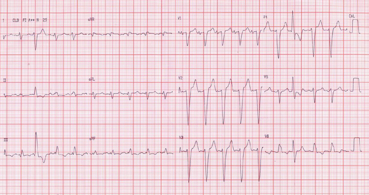 Paciente portador de miocardiopatía dilatada con insuficiencia cardíaca y BCRI