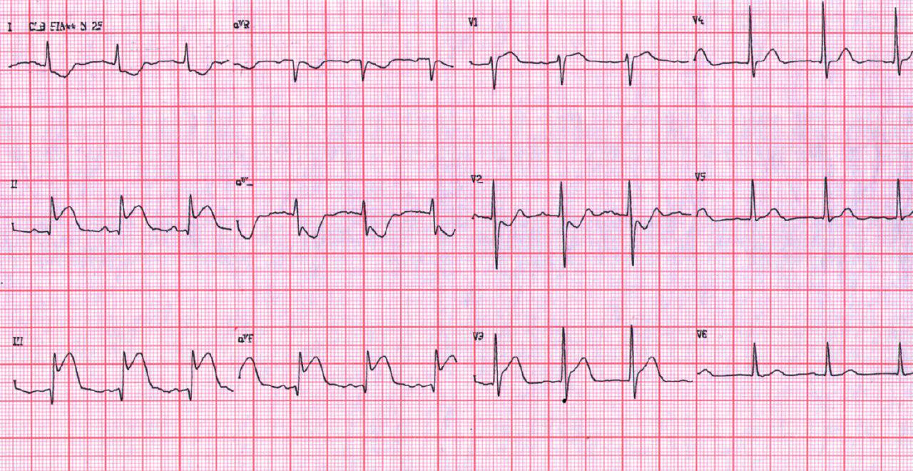 IAM inferior con extensión a VD por oclusión de CD proximal