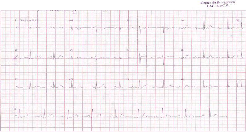 Mujer de 15 años con episodios presincopales desde la infancia por BAVC congénito