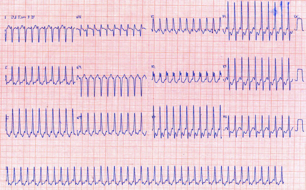 Paciente de 47 años con antecedente de CIA operada que presenta hipertensión pulmonar. AA 1:1