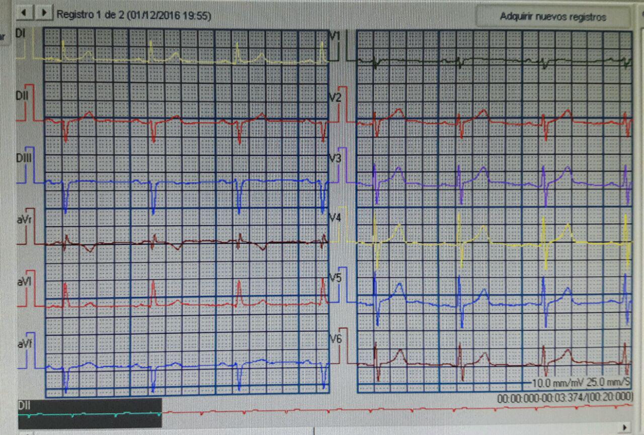 Paciente de 50 años portador de Enfermedad de Chagas que muestra progresión de Hemibloqueo anterior izquierdo a Bloqueo trifascicular en un año