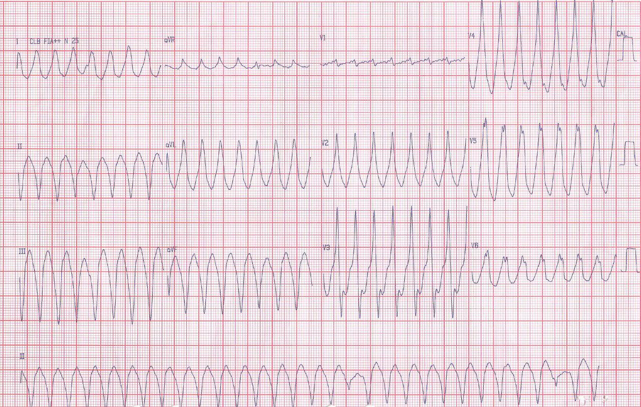 Paciente transplantado hace 14 años, con implante de stents a DA y Cx hace 5 meses. Palpitaciones y disnea