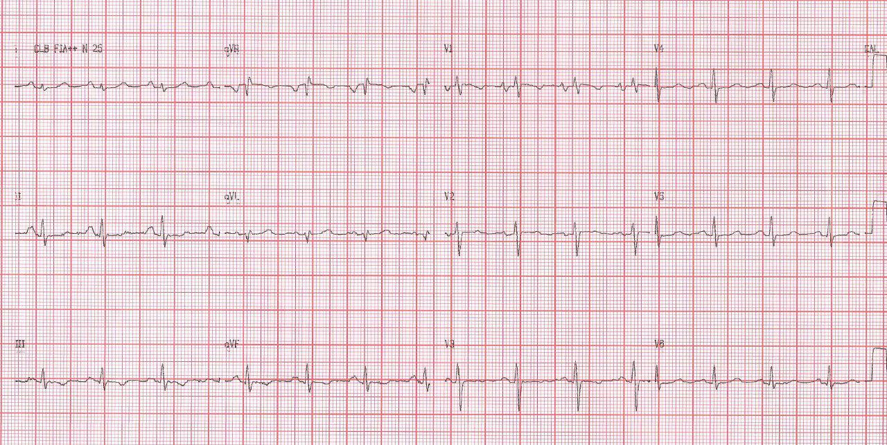 Mujer de 33 años con disnea por estenosis mitral reumática