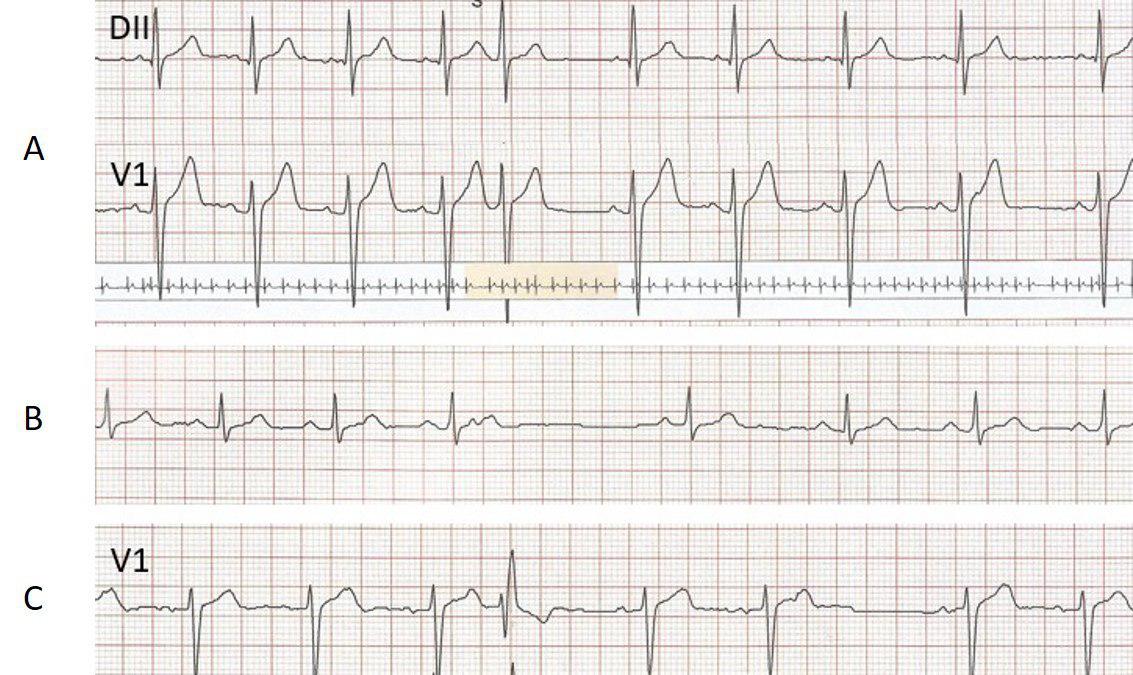 Paciente de 40 años con palpitaciones por extrasistolia auricular de comportamiento variable
