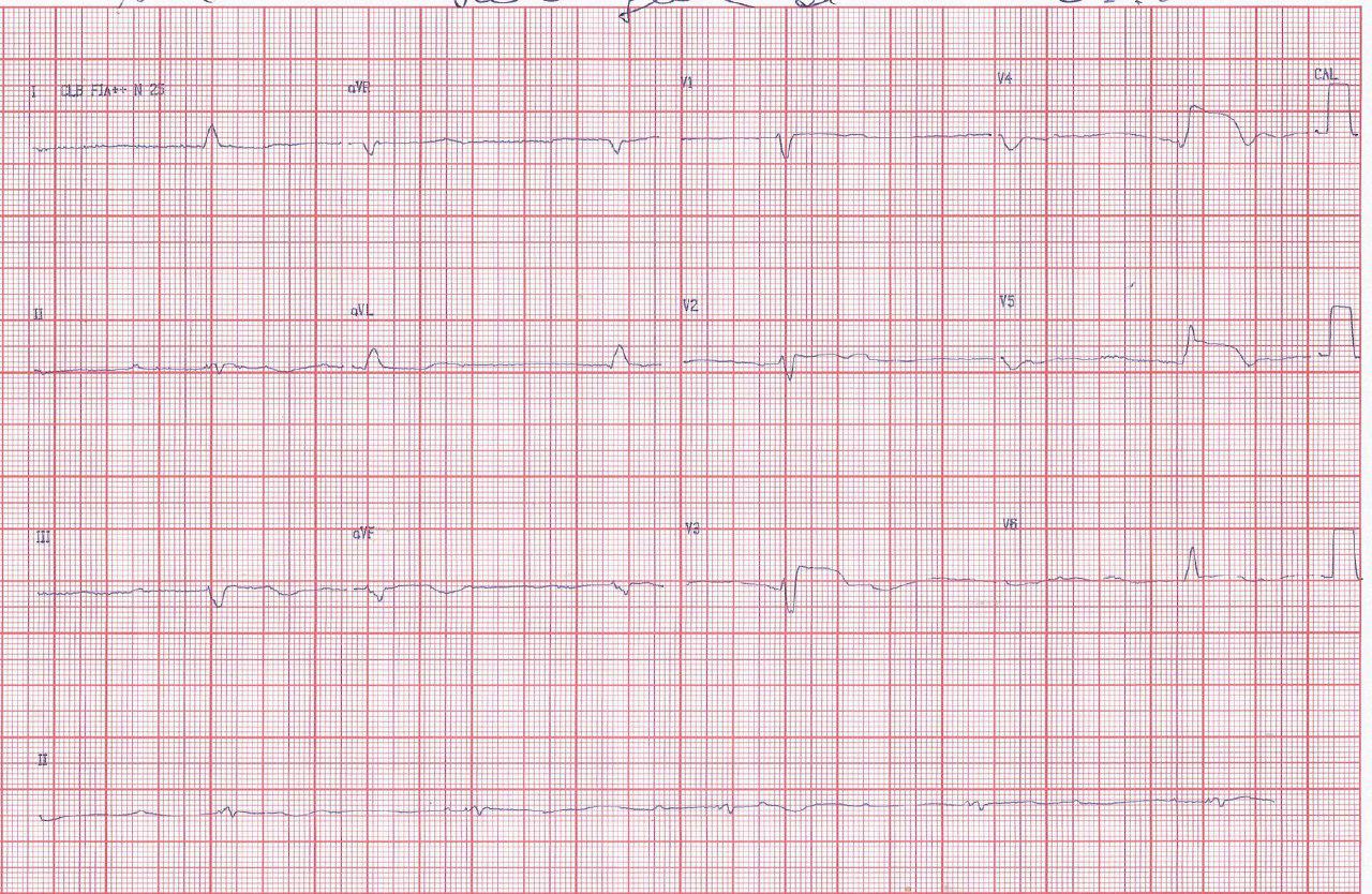 Femenina de 89 años con IAM lateral y BAVC por obstrucción de DA y fracaso de PCI con posterior óbito