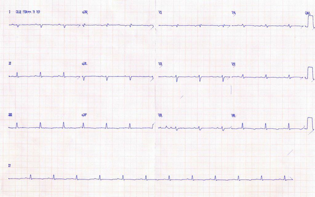 Femenina de 36 años, tiroidectomizada por CA, con cuadro de hipocalcemia; presenta dilatación de cavidades derechas