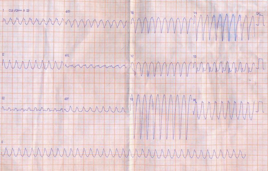 Masculino de 69 años, diabético con epigastralgia y palpitaciones