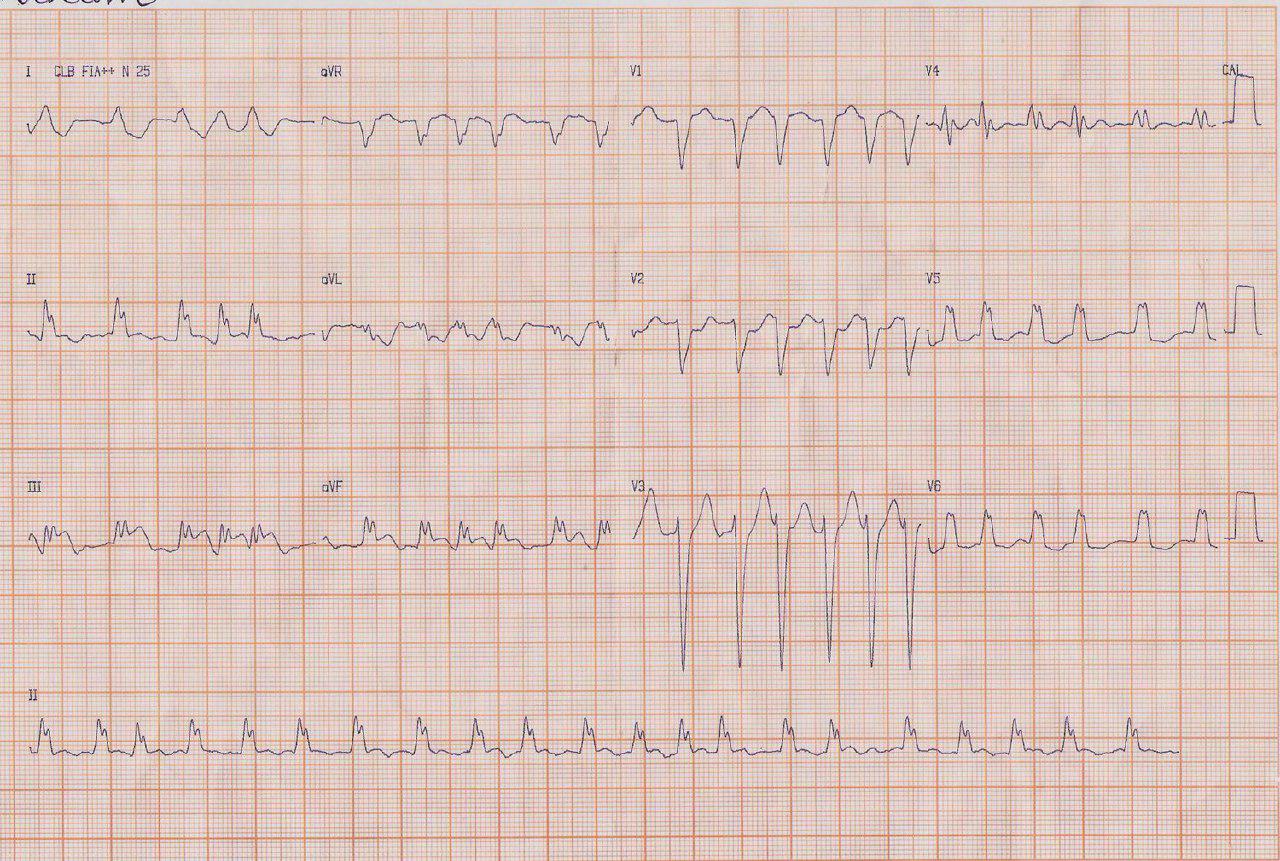 Femenina de 49 años con FA crónica que presenta SCA por probable embolia en coronaria derecha