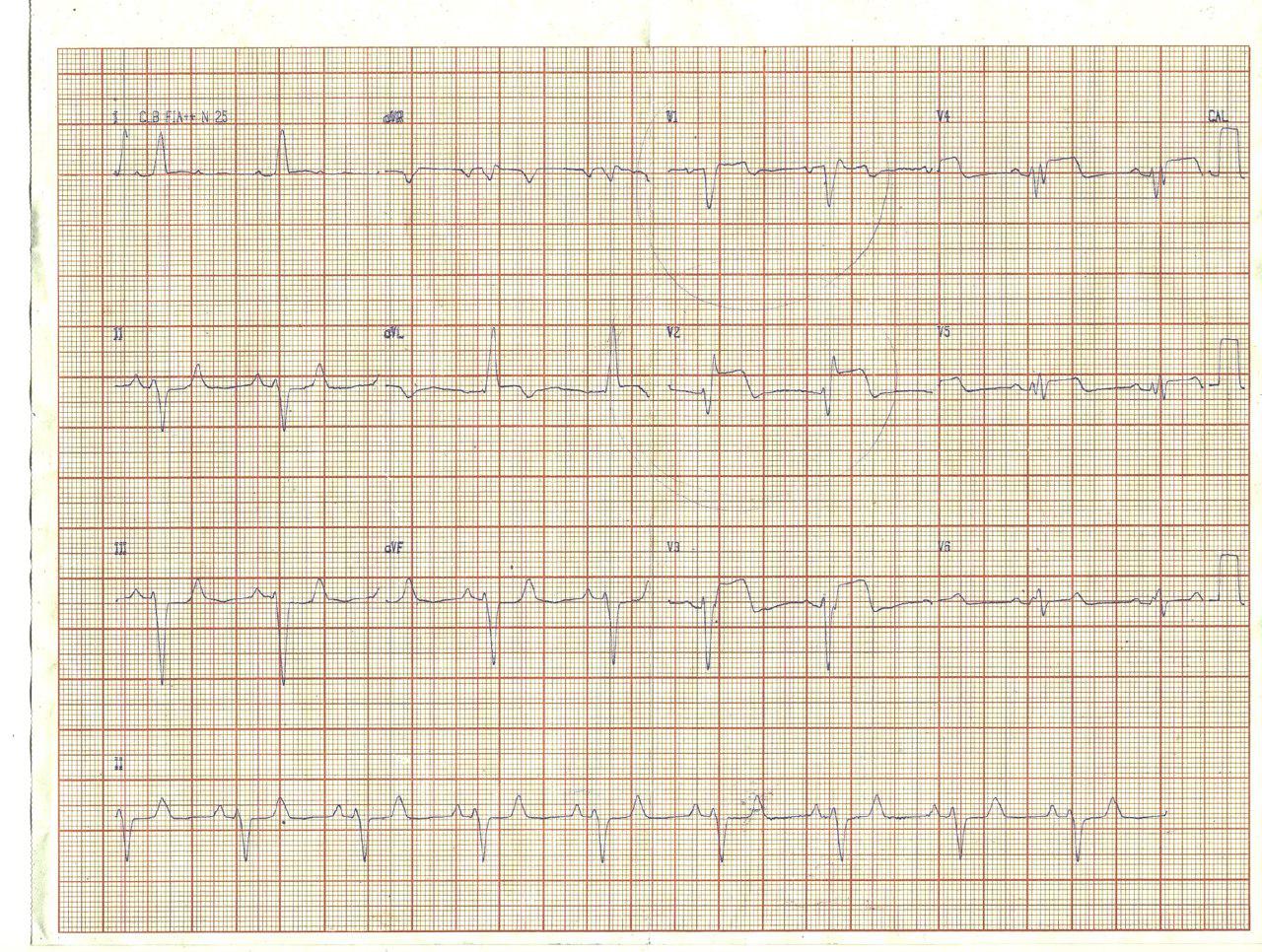Femenina de 46 años con factores de riesgo que desarrolla IAMCEST complicado con BAV de alto grado tratada con angioplastia y que presenta FV irreversible