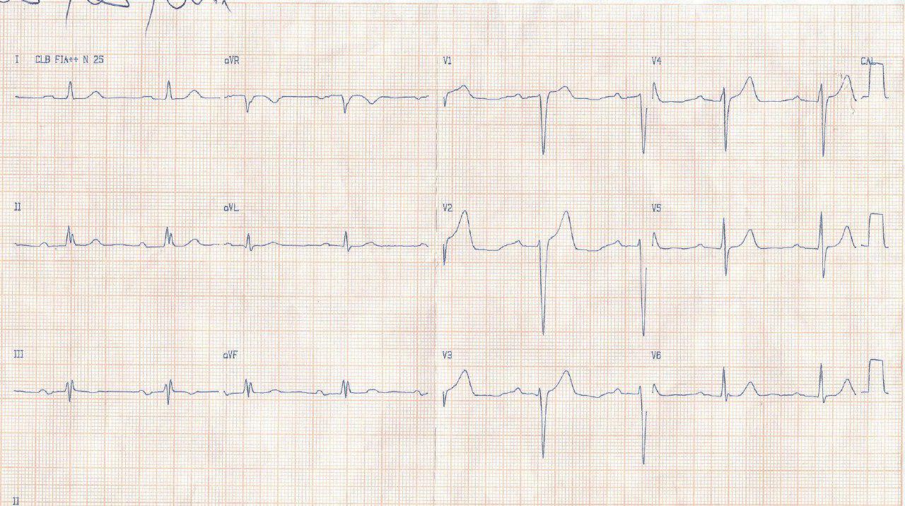 Hombre de 71 años con pérdida progresiva de memoria que presenta síndrome de Bayés, fQRS y hallazgo de MCH asimétrica