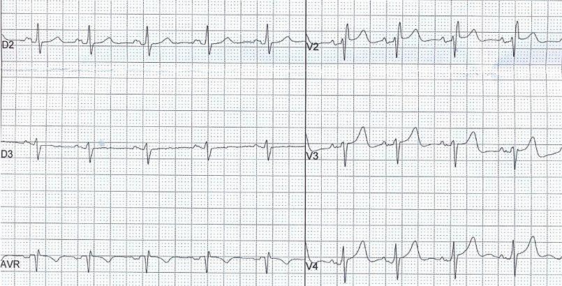 Anciana hipertensa con palpitaciones que presenta un Síndrome de Bayés