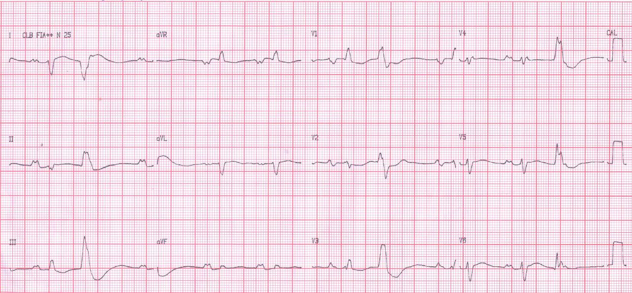 Femenina de 25 años con miocardiopatía hipertrófica severa, presenta FV durante la consulta