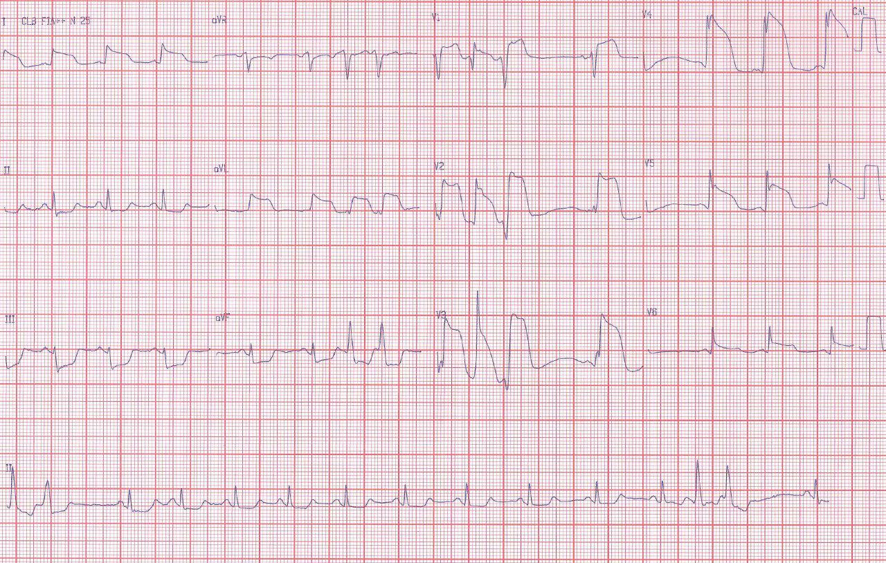 Hombre con angor prolongado que presenta FV que es tratada exitosamente, por suboclusión proximal de la DA