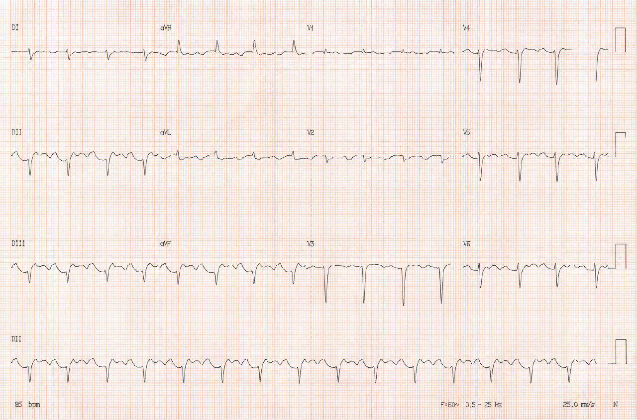Paciente femenina que en el postoperatorio de CIA OS desarrolla aleteo auricular y posterior enfermedad del nódulo sinusal