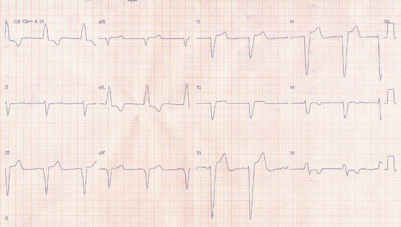 Hombre de 70 años, hipertenso con angor y disnea de esfuerzo, con soplo sistólico por estenosis aórtica grave calcificada y obstrucción importante de la arteria Cx y CD
