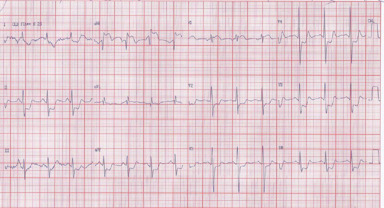 Paciente de 51 años con factores de riesgo que presenta angor y episodio sincopal en el que la CCG constata lesión de TCI