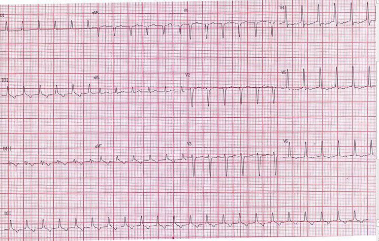 Paciente de 47 años que presenta taquicardia ortodrómica por vía anómala que se controla con amiodarona a posteriori de lo cual presenta síncope con constatación de QT largo