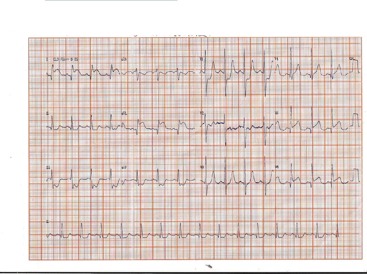 Paciente de 58 años con múltiples factores de riesgo con SCA por obstrucción del 100% de la DA con presencia de trombo