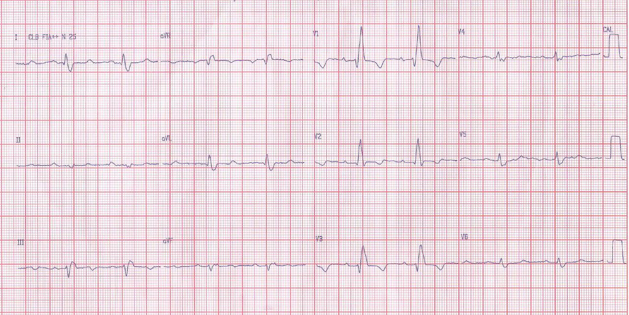 Paciente de 56 años con transplante cardíaco hace 8 que presenta BCRD + BDAM y crecimiento de VD