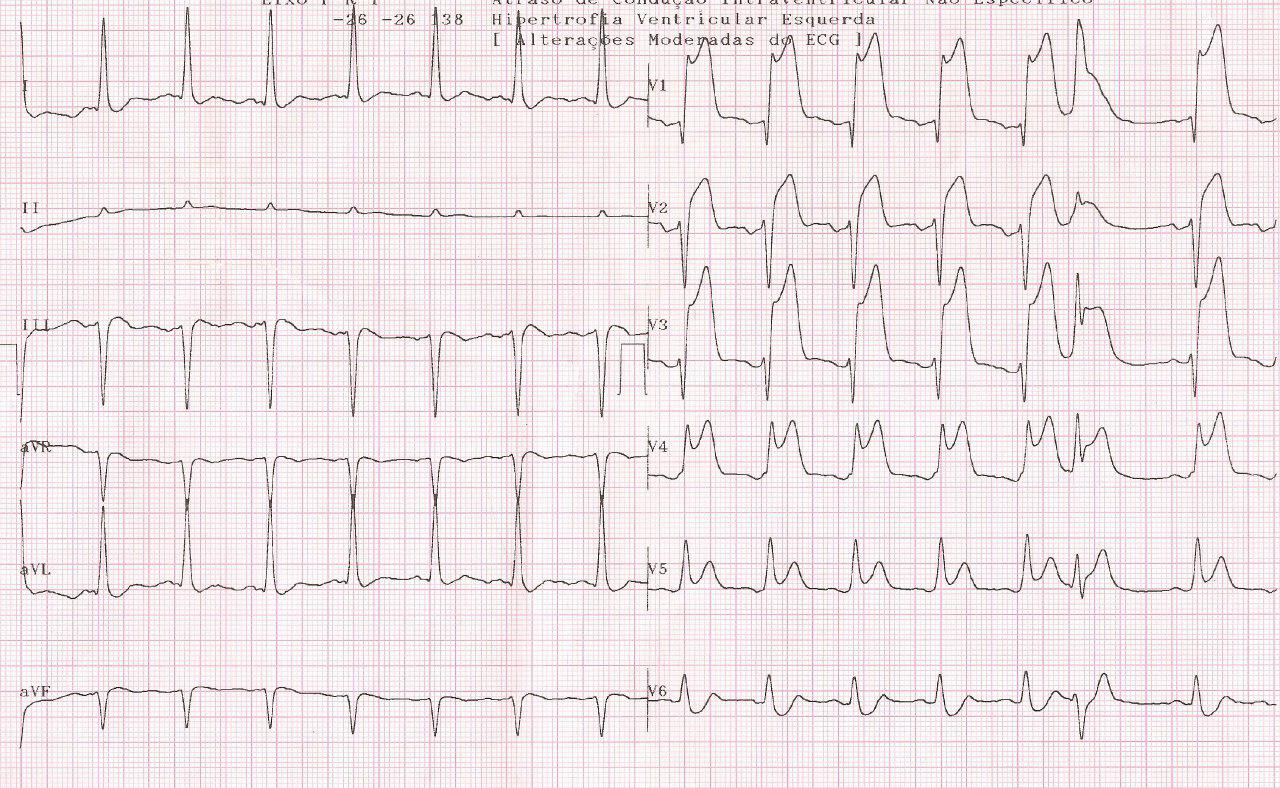 Hombre de 69 años con IAM hiperagudo de cara anterior por suboclusión de la DA con trombo que es aspirado y posterior angioplastia exitosa
