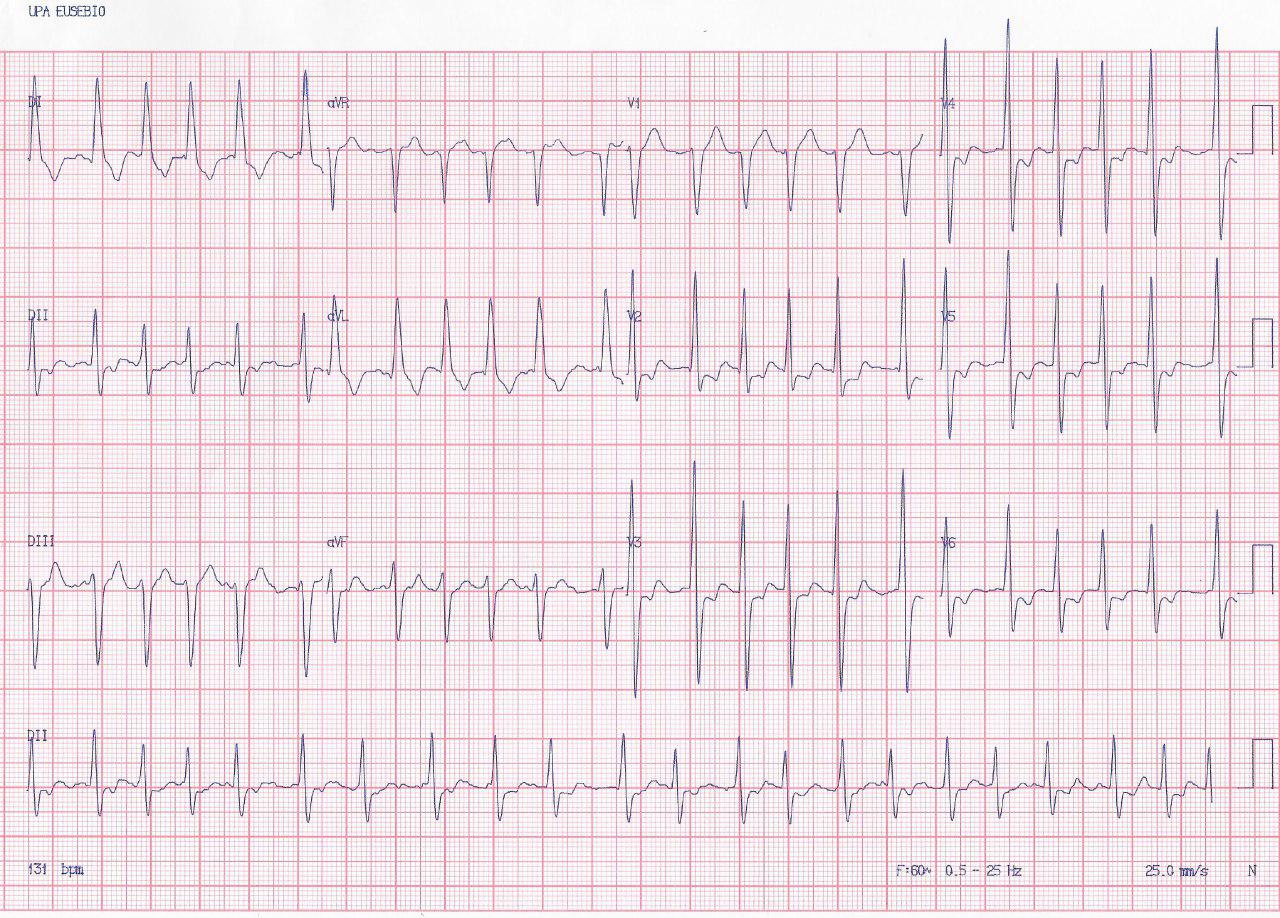 Hombre de 75 años con antecedente de implante de stent consulta por angor y FA de alta respuesta que revierte con amiodarona y presenta obstrucción crítica intrastent