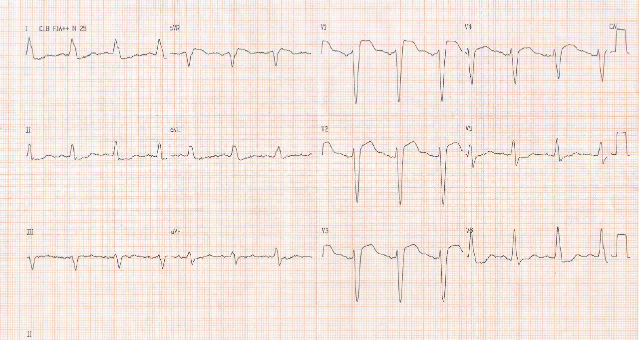 Paciente de 89 años, digitalizada crónica, con dolor precordial con troponina y CCG normales