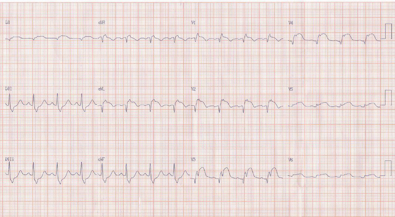 Mujer de 51 años con angor prolongado por IAM anterior por obstrucción severa de TCI y lesión segmentaria de DA