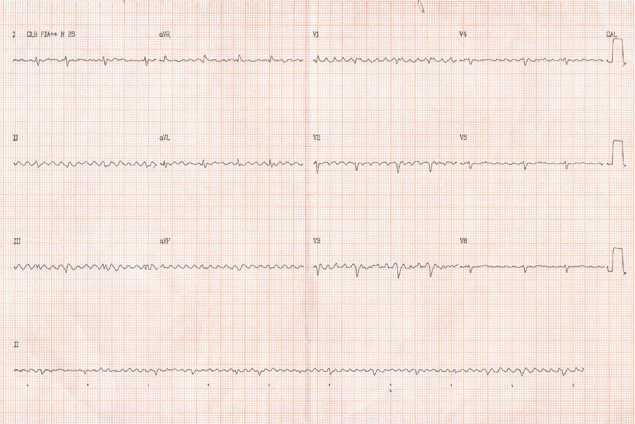 Mujer de 54 años con disnea, edemas generalizados y abdomen distendido por pericarditis constrictiva crónica severa