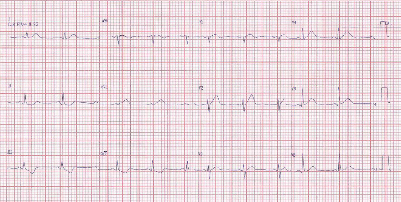 Paciente femenina de 72 años con SCA por oclusión de DA proximal