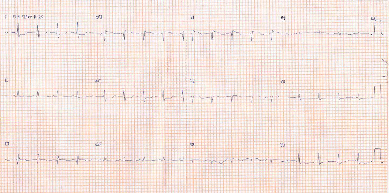Mujer 46 años portadora de púrpura trombocitopénica idiopática, con disnea súbita y síncope por TEP bilateral