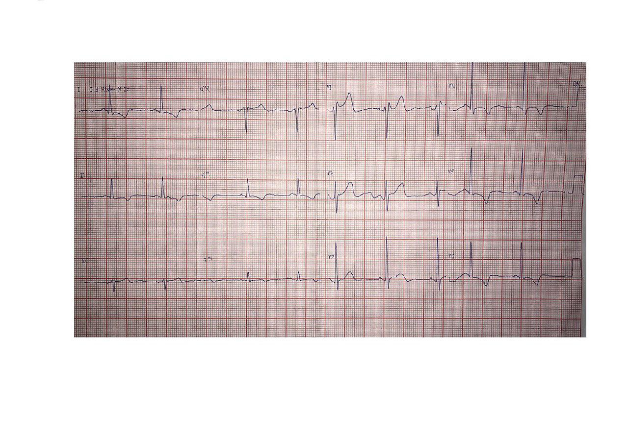 Hombre de 60 años con disnea y síncope por miocardiopatía hipertrófica obstructiva