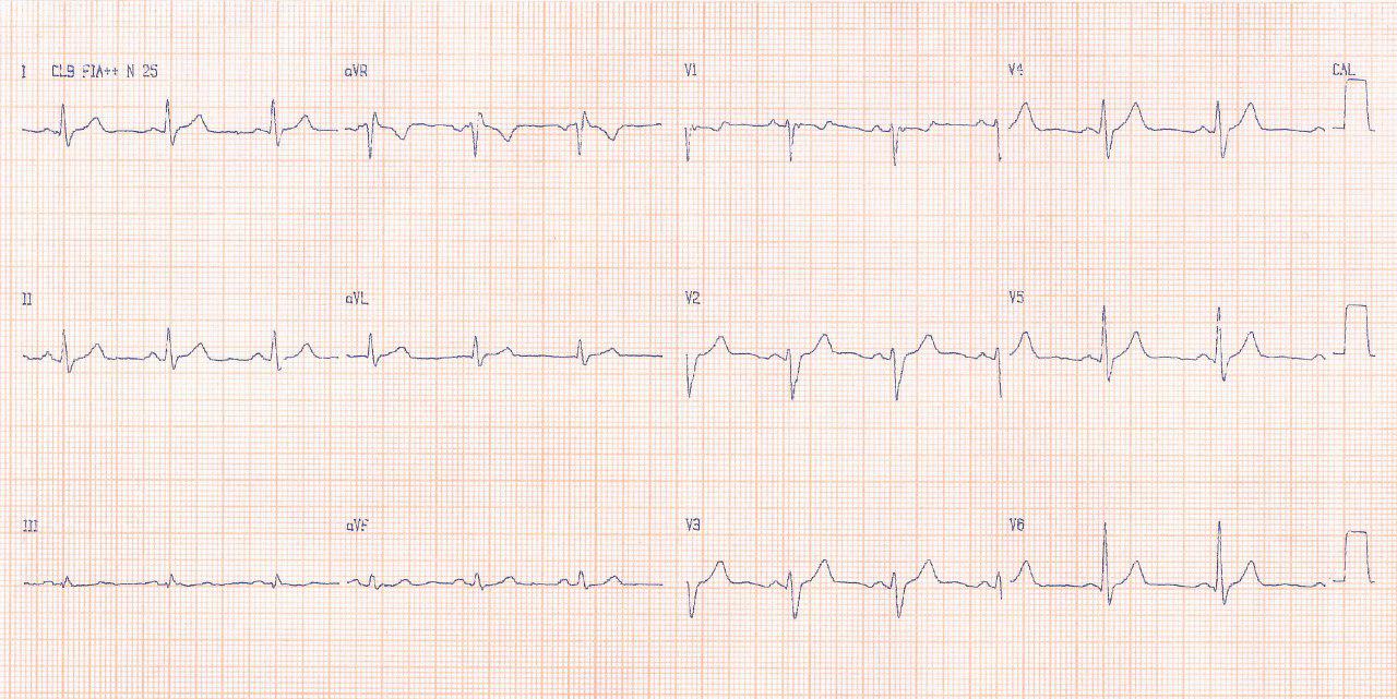 Mujer de 37 años con disnea y palpitaciones presenta soplo sistólico en foco pulmonar por CIA tipo ostium secundum y aneurisma septal